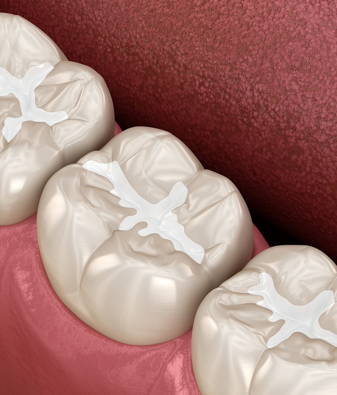 Illustrated row of teeth with white dental sealants