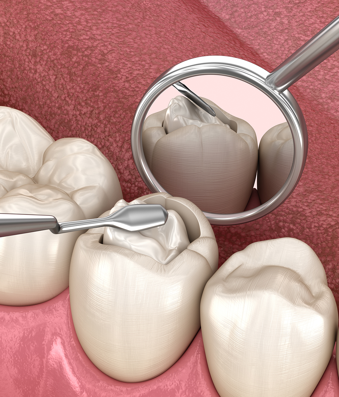 Illustrated filling being placed inside of a tooth